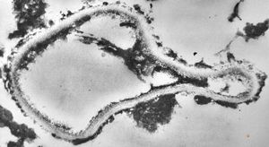 M,59y. | Histoplasma capsulatum - lung M,59y. | Histoplasma capsulatum - lung